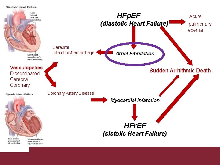 HFp. EF Acute (diastolic Heart Failure) Cerebral Infarction/hemorrhage pulmonary edema Atrial Fibrillation Vasculopaties Disseminated