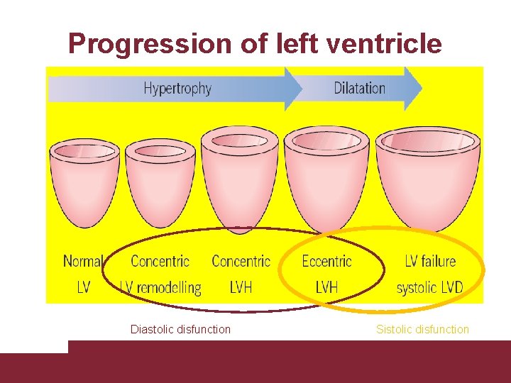 Progression of left ventricle morphology Diastolic disfunction Sistolic disfunction Congestive Heart Failure 26/11/2020 Pagina