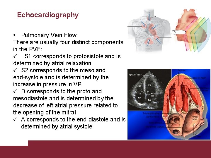 Echocardiography • Pulmonary Vein Flow: There are usually four distinct components in the PVF: