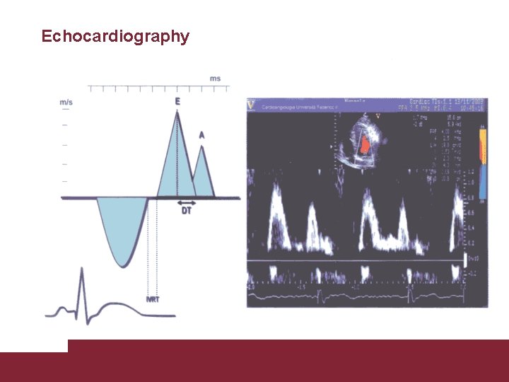 Echocardiography Congestive Heart Failure 26/11/2020 Pagina 31 