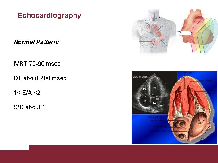 Echocardiography Normal Pattern: IVRT 70 -90 msec DT about 200 msec 1< E/A <2