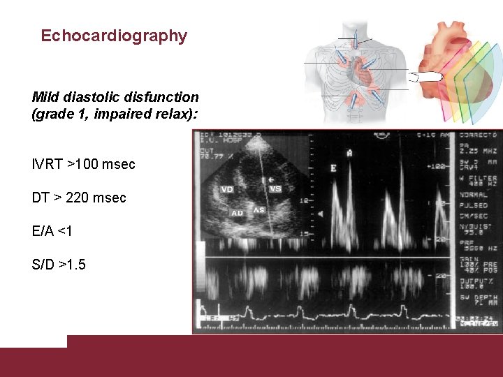 Echocardiography Mild diastolic disfunction (grade 1, impaired relax): IVRT >100 msec DT > 220