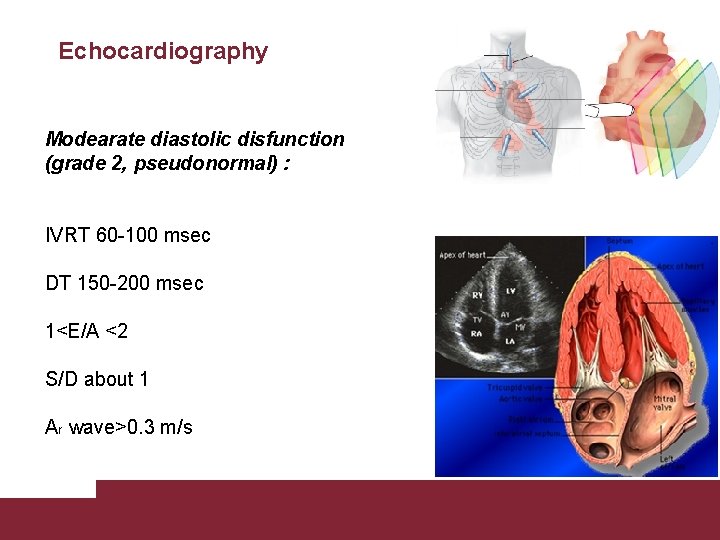 Echocardiography Modearate diastolic disfunction (grade 2, pseudonormal) : IVRT 60 -100 msec DT 150