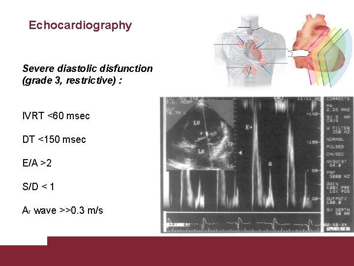 Echocardiography Severe diastolic disfunction (grade 3, restrictive) : IVRT <60 msec DT <150 msec