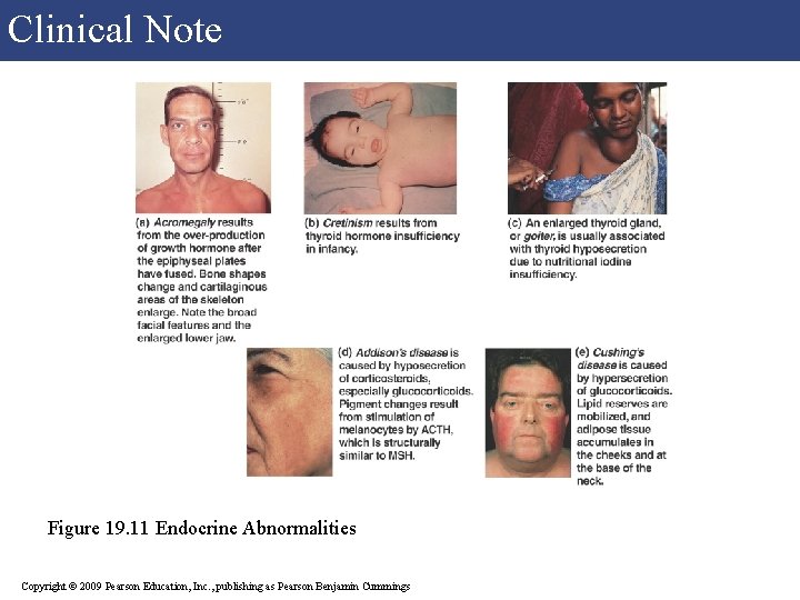 Clinical Note Figure 19. 11 Endocrine Abnormalities Copyright © 2009 Pearson Education, Inc. ,