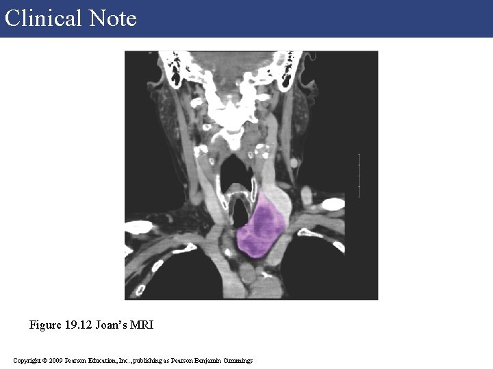 Clinical Note Figure 19. 12 Joan’s MRI Copyright © 2009 Pearson Education, Inc. ,