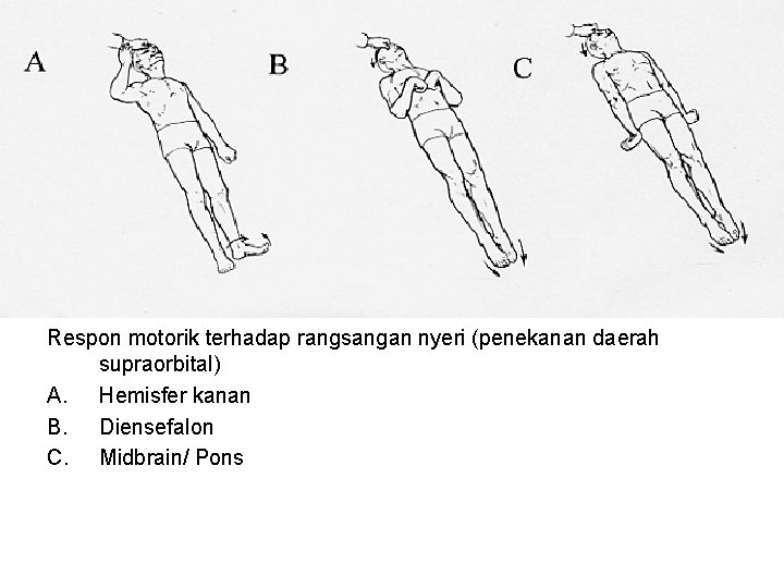 Respon motorik terhadap rangsangan nyeri (penekanan daerah supraorbital) A. Hemisfer kanan B. Diensefalon C.