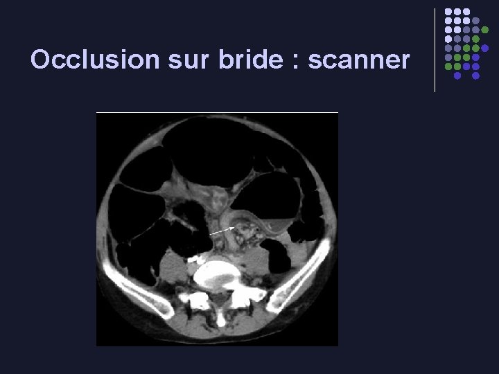 Occlusion sur bride : scanner 