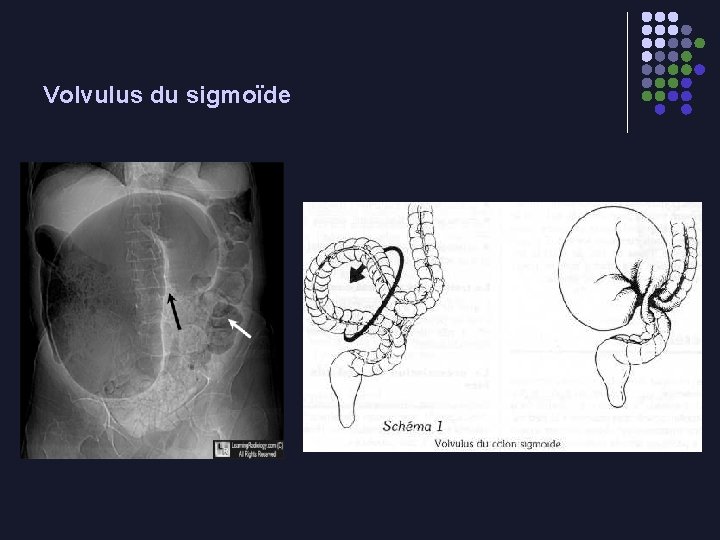 Volvulus du sigmoïde 