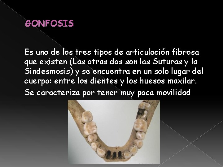 GONFOSIS Es uno de los tres tipos de articulación fibrosa que existen (Las otras GONFOSIS Es uno de los tres tipos de articulación fibrosa que existen (Las otras