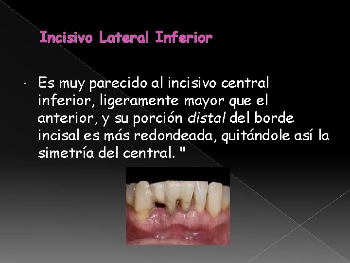 Incisivo Lateral Inferior Es muy parecido al incisivo central inferior, ligeramente mayor que el Incisivo Lateral Inferior Es muy parecido al incisivo central inferior, ligeramente mayor que el