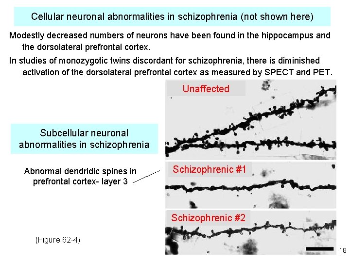Cellular neuronal abnormalities in schizophrenia (not shown here) Modestly decreased numbers of neurons have