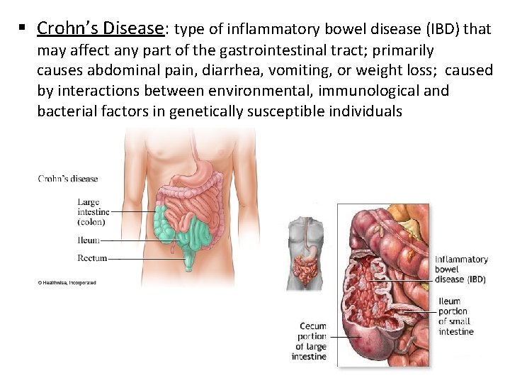 § Crohn’s Disease: type of inflammatory bowel disease (IBD) that may affect any part
