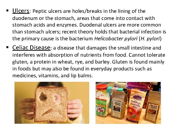 § Ulcers: Peptic ulcers are holes/breaks in the lining of the duodenum or the