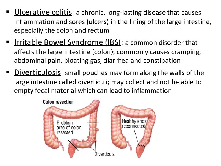 § Ulcerative colitis: a chronic, long-lasting disease that causes inflammation and sores (ulcers) in
