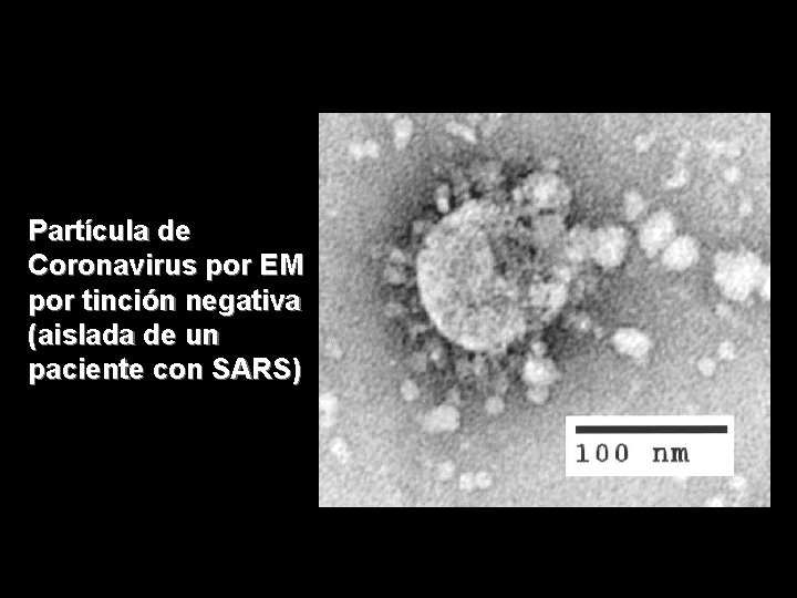 Partícula de Coronavirus por EM por tinción negativa (aislada de un paciente con SARS)