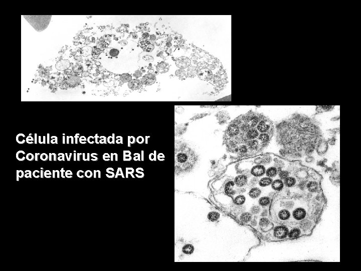 Célula infectada por Coronavirus en Bal de paciente con SARS 