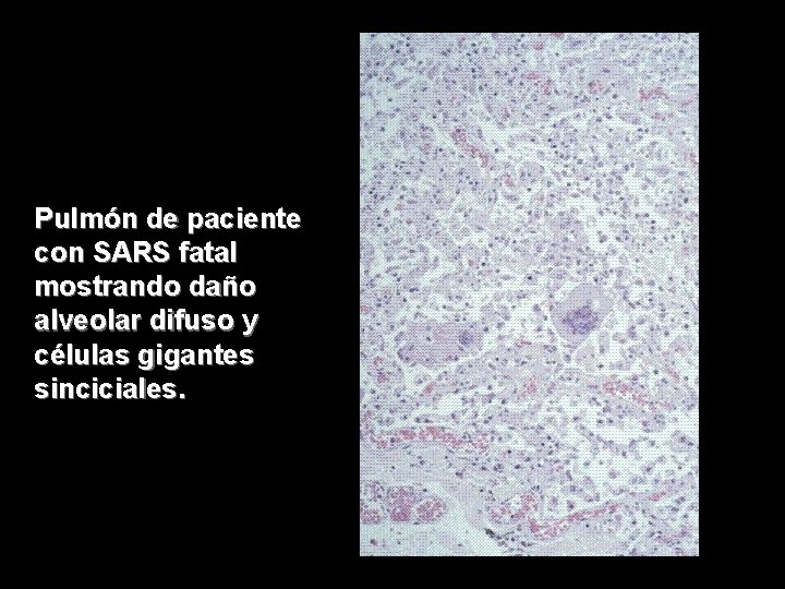 Pulmón de paciente con SARS fatal mostrando daño alveolar difuso y células gigantes sinciciales.