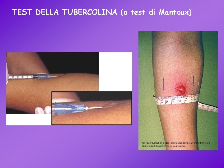 TEST DELLA TUBERCOLINA (o test di Mantoux) 