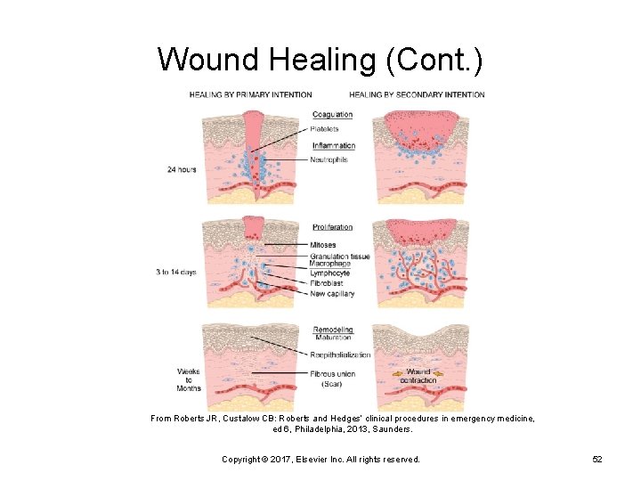 Wound Healing (Cont. ) From Roberts JR, Custalow CB: Roberts and Hedges’ clinical procedures