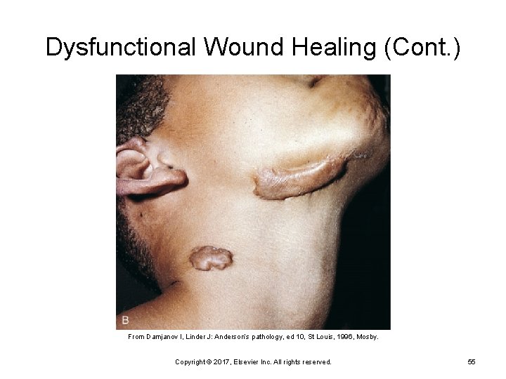 Dysfunctional Wound Healing (Cont. ) From Damjanov I, Linder J: Anderson’s pathology, ed 10,