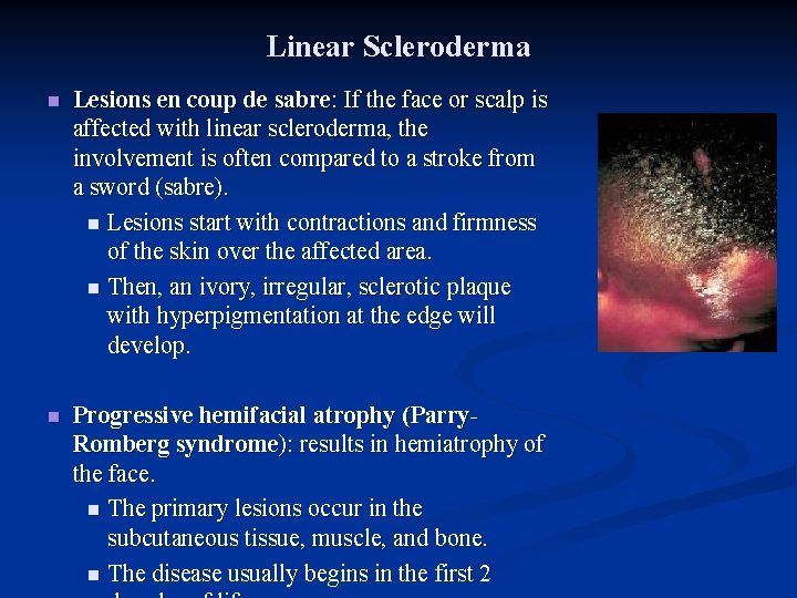 Linear Scleroderma n Lesions en coup de sabre: If the face or scalp is
