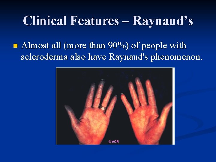 Clinical Features – Raynaud’s n Almost all (more than 90%) of people with scleroderma