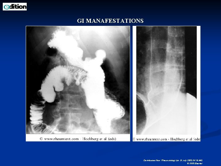 GI MANAFESTATIONS Downloaded from: Rheumatology (on 31 July 2005 04: 16 AM) © 2005