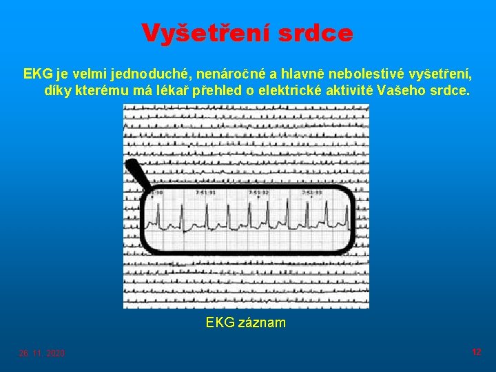 Vyšetření srdce EKG je velmi jednoduché, nenáročné a hlavně nebolestivé vyšetření, díky kterému má