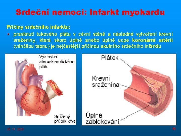 Srdeční nemoci: Infarkt myokardu Příčiny srdečního infarktu: prasknutí tukového plátu v cévní stěně a