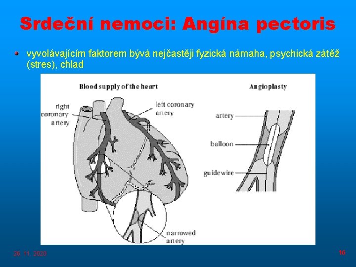 Srdeční nemoci: Angína pectoris vyvolávajícím faktorem bývá nejčastěji fyzická námaha, psychická zátěž (stres), chlad