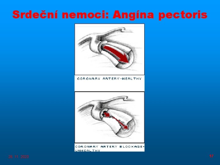Srdeční nemoci: Angína pectoris 26. 11. 2020 17 