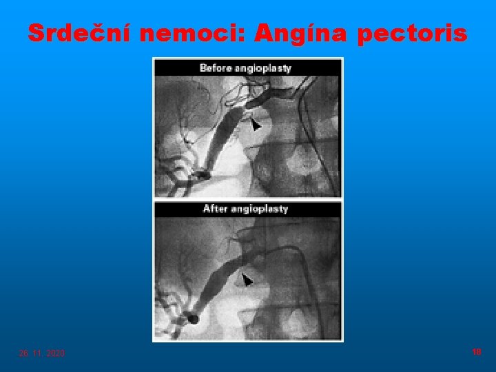 Srdeční nemoci: Angína pectoris 26. 11. 2020 18 