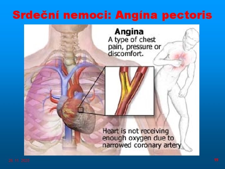 Srdeční nemoci: Angína pectoris 26. 11. 2020 19 