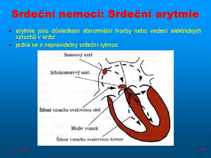 Srdeční nemoci: Srdeční arytmie jsou důsledkem abnormální tvorby nebo vedení elektrických vzruchů v srdci