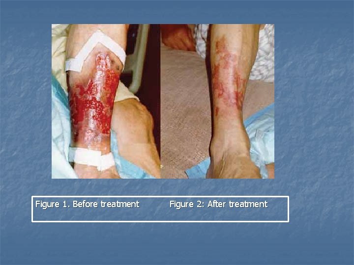 Figure 1. Before treatment Figure 2: After treatment 
