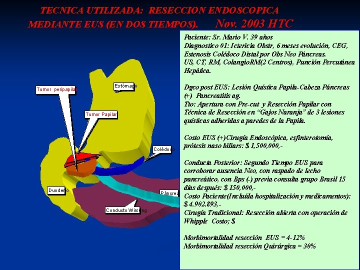 TECNICA UTILIZADA: RESECCION ENDOSCOPICA Nov. 2003 HTC MEDIANTE EUS (EN DOS TIEMPOS). Paciente: Sr.
