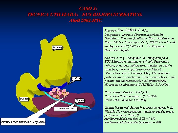 CASO 3: TECNICA UTILIZADA: EUS BILIOPANCREATICO. Abril 2002. HTC Paciente: Sra. Lidia LL SS.