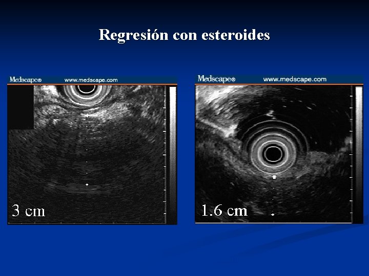 Regresión con esteroides Un unusual cause of pancreatitis. Medscape Gastroenterology 