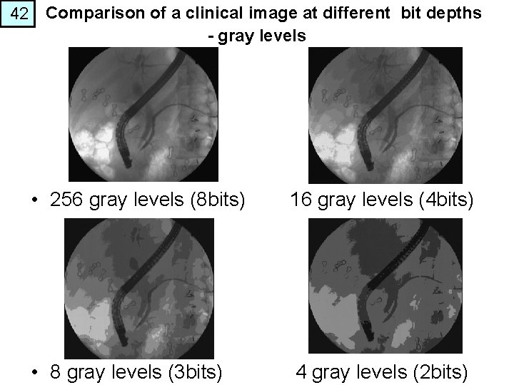 42 Comparison of a clinical image at different bit depths - gray levels •