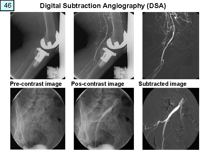 46 Digital Subtraction Angiography (DSA) Pre-contrast image Pos-contrast image Subtracted image 