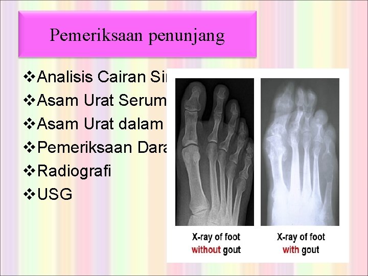 Pemeriksaan penunjang v. Analisis Cairan Sinovial v. Asam Urat Serum v. Asam Urat dalam