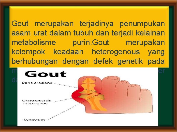 Gout merupakan terjadinya penumpukan asam urat dalam tubuh dan terjadi kelainan metabolisme purin. Gout