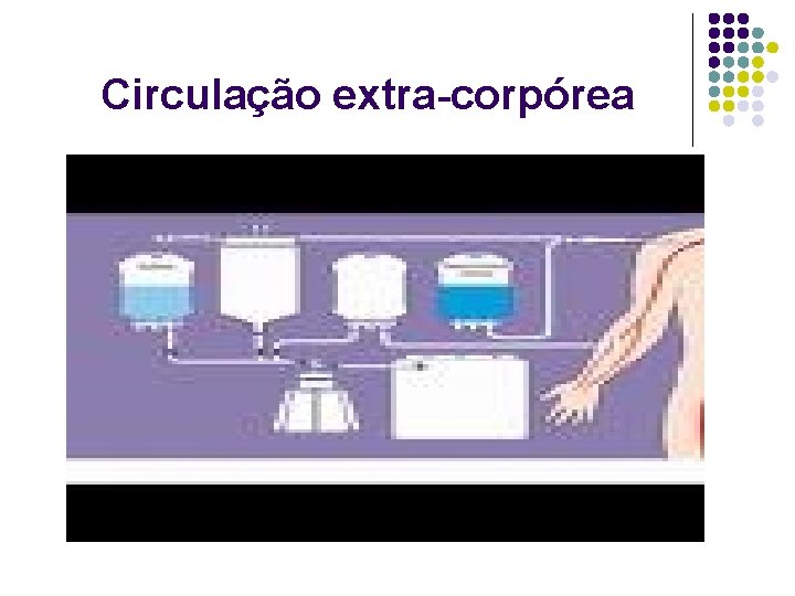 Circulação extra-corpórea 