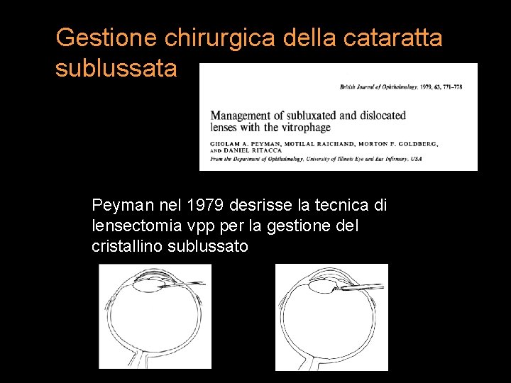 Gestione chirurgica della cataratta sublussata Peyman nel 1979 desrisse la tecnica di lensectomia vpp