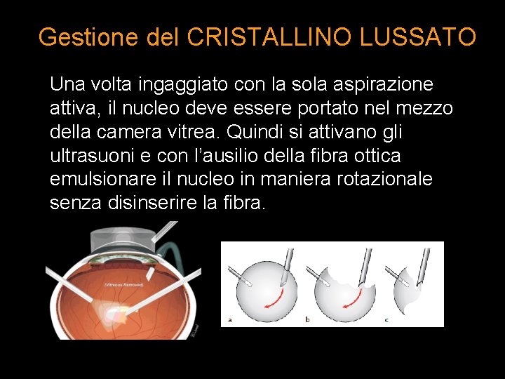 Gestione del CRISTALLINO LUSSATO Una volta ingaggiato con la sola aspirazione attiva, il nucleo