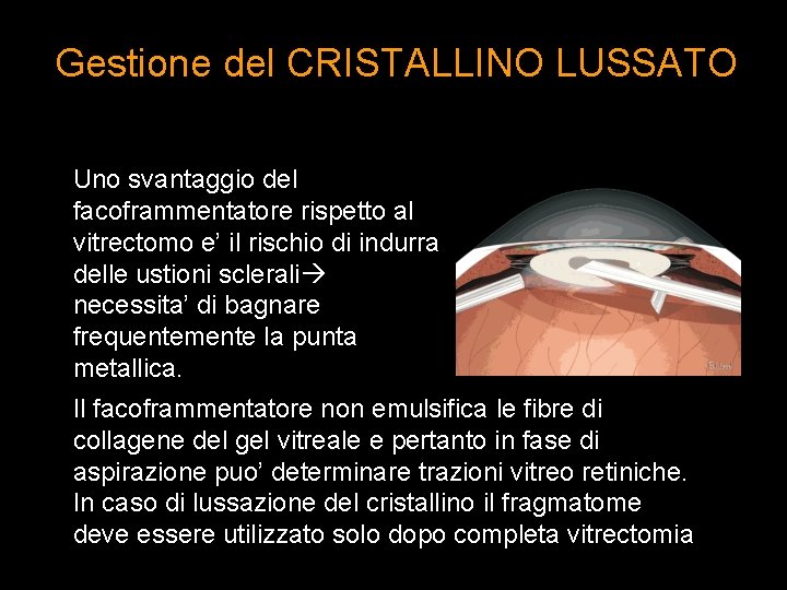 Gestione del CRISTALLINO LUSSATO Uno svantaggio del facoframmentatore rispetto al vitrectomo e’ il rischio