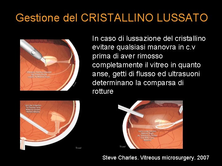 Gestione del CRISTALLINO LUSSATO In caso di lussazione del cristallino evitare qualsiasi manovra in