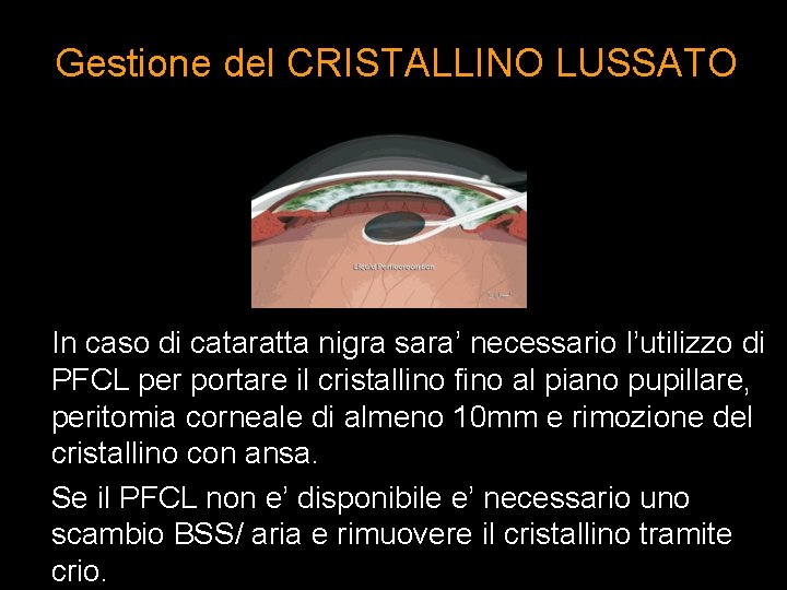 Gestione del CRISTALLINO LUSSATO In caso di cataratta nigra sara’ necessario l’utilizzo di PFCL