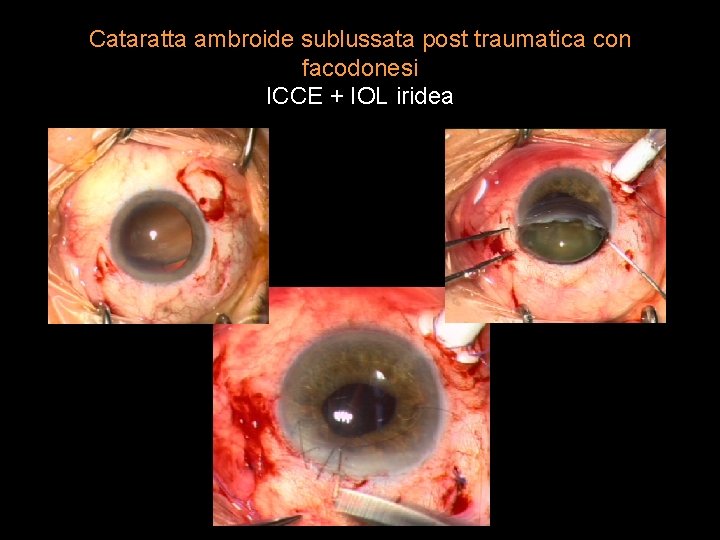 Cataratta ambroide sublussata post traumatica con facodonesi ICCE + IOL iridea 